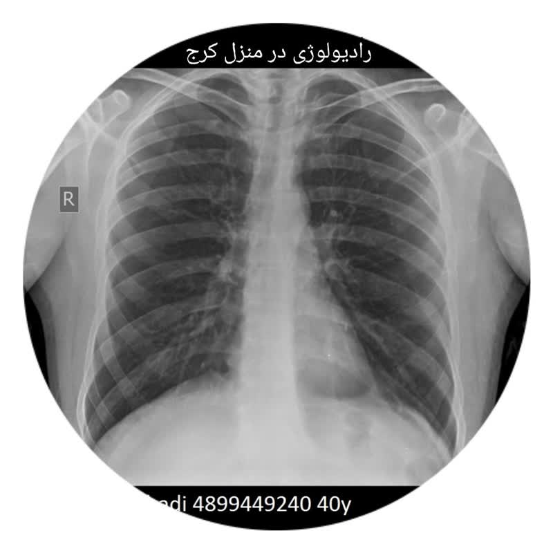 رادیولوژی در منزل کرج البرز از ریه و قفسه سینه و دنده و مچ پا انگشت دست و پا